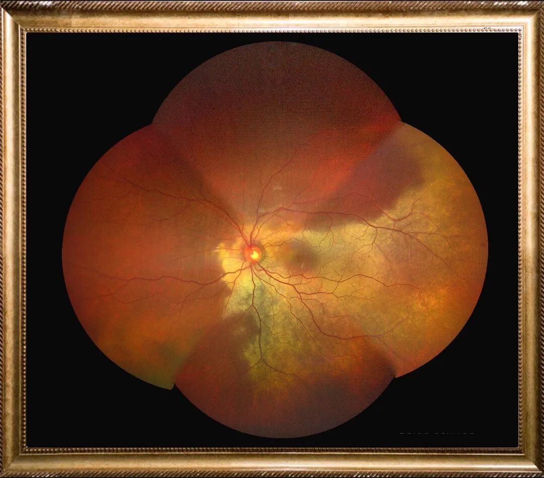 眼底照相机怎么眼底一张照眼病早知道丨蔡司CLARUS 500真彩·高清·超广角眼底相机_https://www.jmylbn.com_新闻资讯_第2张