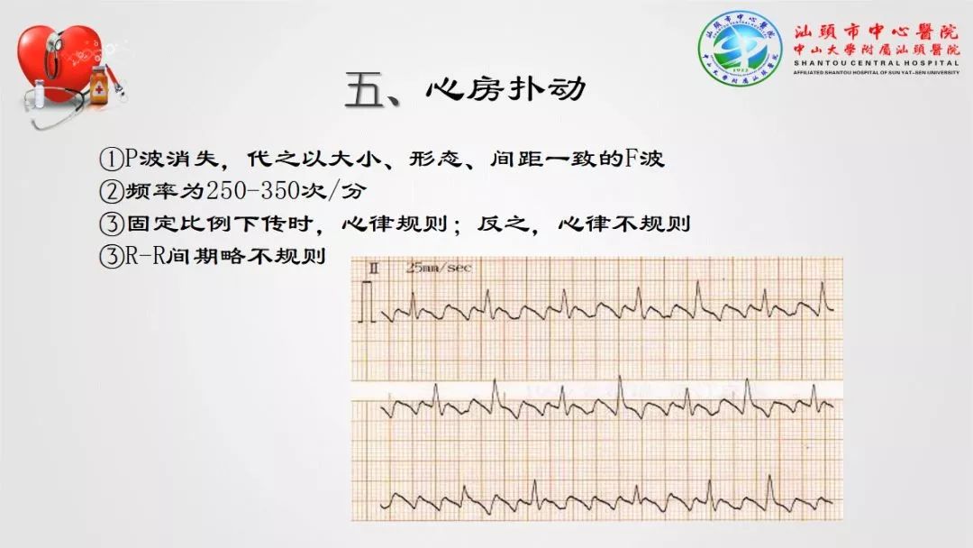 心肌梗死心律失常異常心電圖大盤點