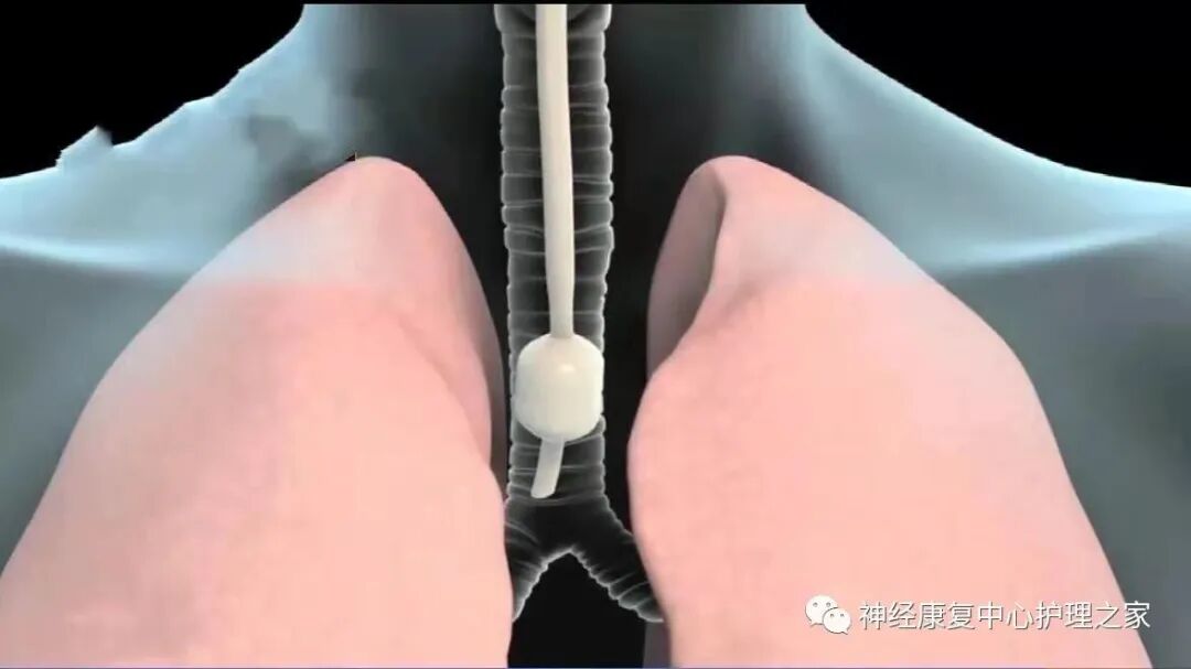 气管插管导丝有什么用【干货】气管插管相关知识_https://www.jmylbn.com_新闻资讯_第5张