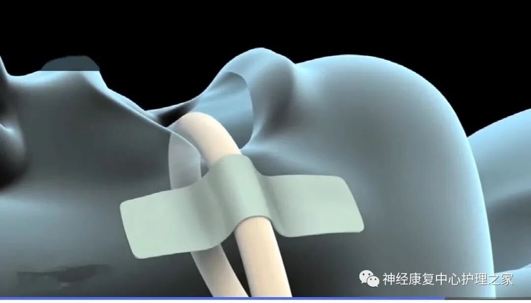 气管插管导丝有什么用【干货】气管插管相关知识_https://www.jmylbn.com_新闻资讯_第6张