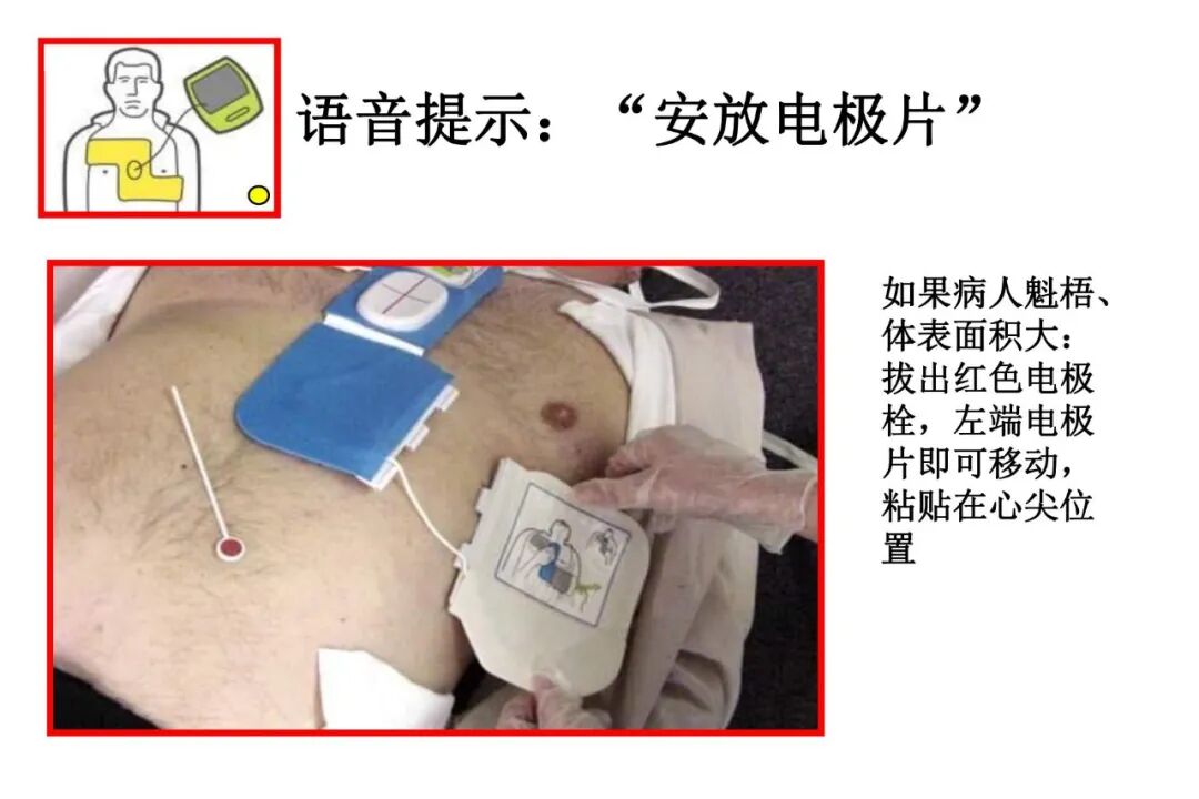 什么是aed除颤【急救科普】自动体外除颤器（AED）使用及注意事项_https://www.jmylbn.com_新闻资讯_第32张