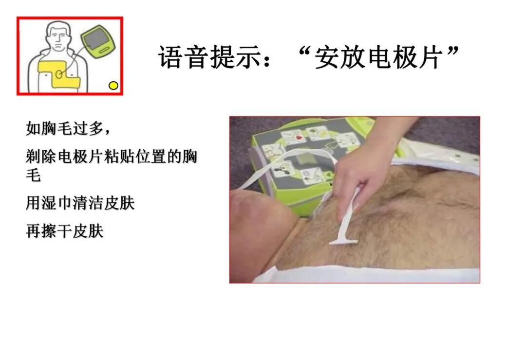 什么是aed除颤【急救科普】自动体外除颤器（AED）使用及注意事项_https://www.jmylbn.com_新闻资讯_第27张