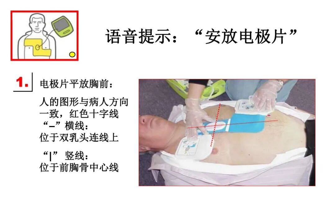 什么是aed除颤【急救科普】自动体外除颤器（AED）使用及注意事项_https://www.jmylbn.com_新闻资讯_第30张
