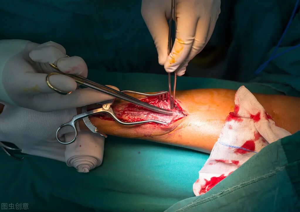 缝伤口怎么打结急诊外科必备技能——清创缝合术_https://www.jmylbn.com_新闻资讯_第2张