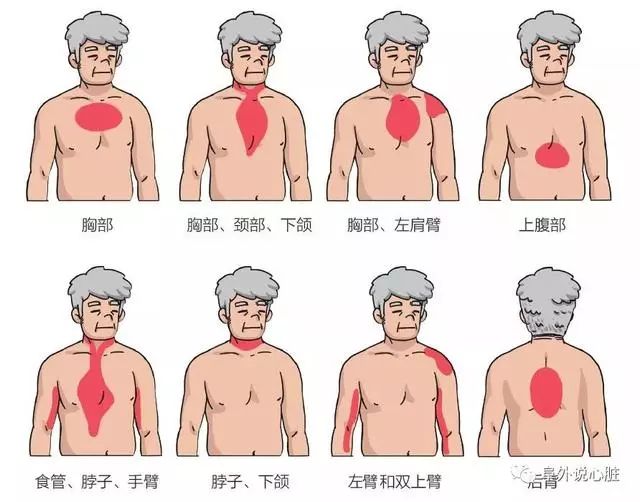 三甲规培教案：急性心肌梗死的临床大全