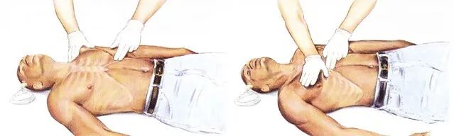 cpr按压板怎么用心肺复苏术的操作方法_https://www.jmylbn.com_新闻资讯_第6张