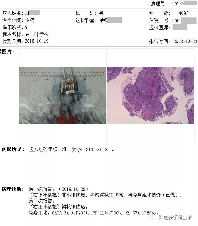 



肺鳞癌三线PD-1抗体+安罗替尼的疗效远超预期
