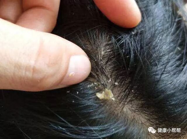 头发很痒，还能抠出白泥？元凶太多人却容易忽视