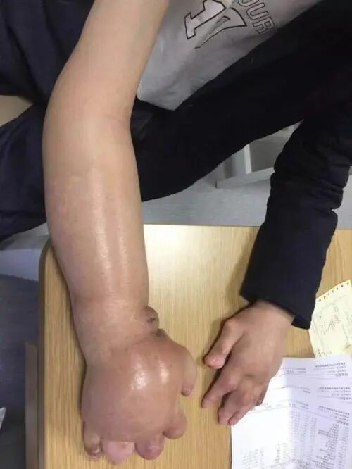 乳腺手术怎么加压包扎乳腺癌手术后如何护理可以预防手臂水肿！_https://www.jmylbn.com_新闻资讯_第2张