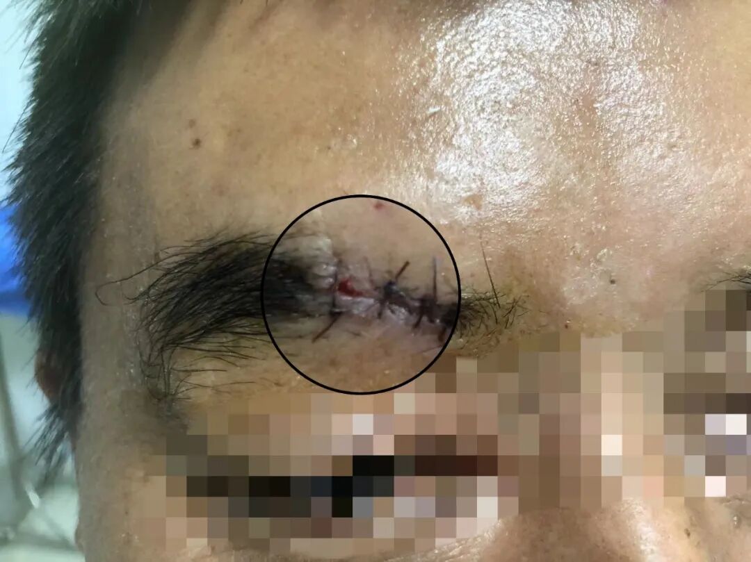 什么是无创缝合精细美容缝合／伤口组织胶水技术项目，让您的伤口疤痕最小化_https://www.jmylbn.com_新闻资讯_第5张