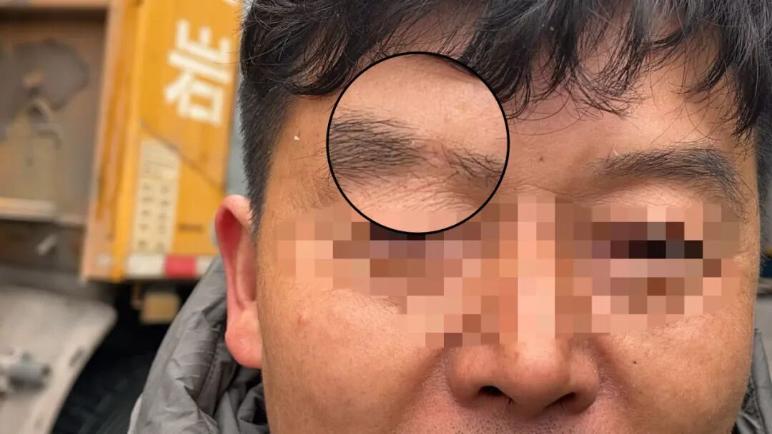 什么是无创缝合精细美容缝合／伤口组织胶水技术项目，让您的伤口疤痕最小化_https://www.jmylbn.com_新闻资讯_第6张