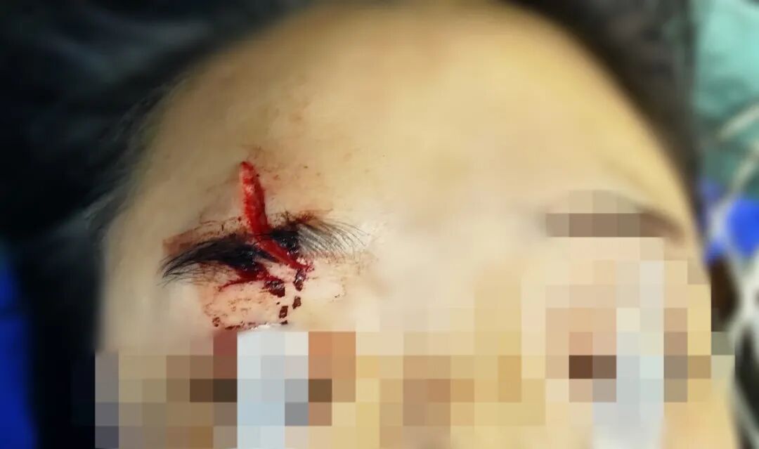 什么是无创缝合精细美容缝合／伤口组织胶水技术项目，让您的伤口疤痕最小化_https://www.jmylbn.com_新闻资讯_第2张