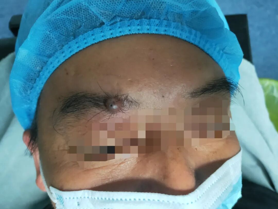 什么是无创缝合精细美容缝合／伤口组织胶水技术项目，让您的伤口疤痕最小化_https://www.jmylbn.com_新闻资讯_第4张