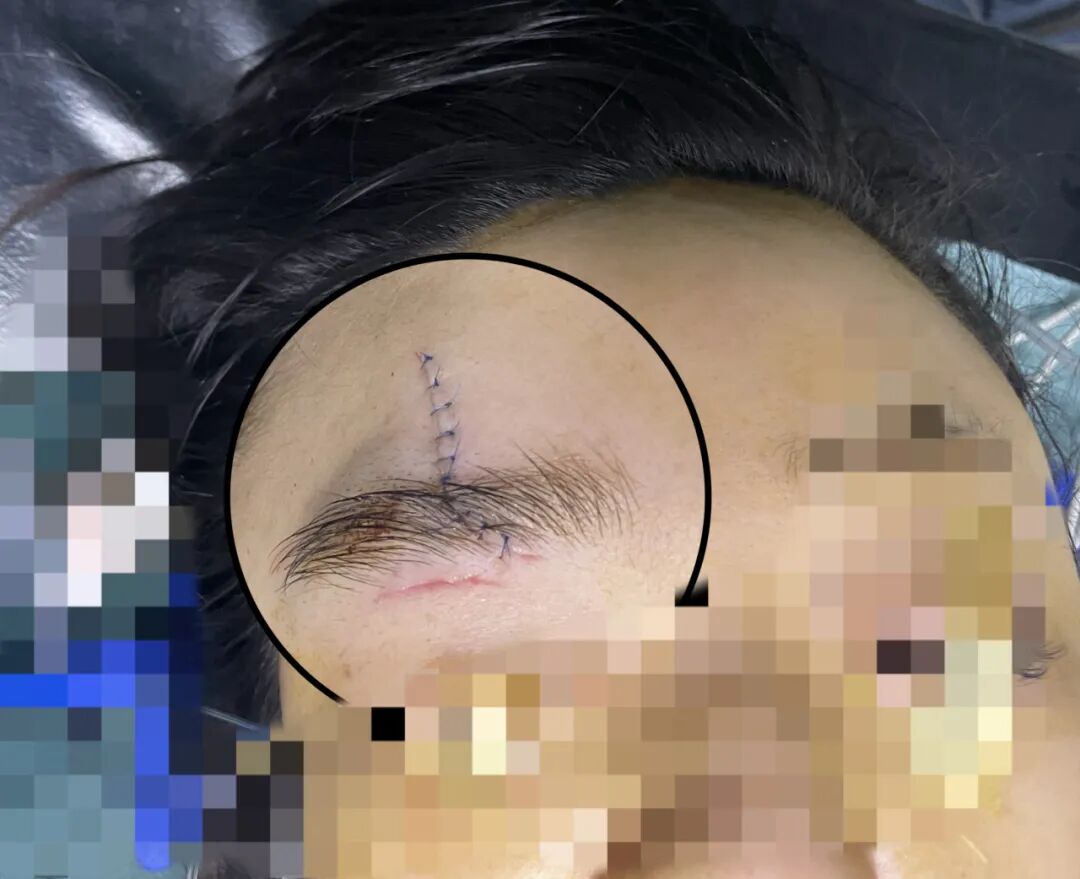 什么是无创缝合精细美容缝合／伤口组织胶水技术项目，让您的伤口疤痕最小化_https://www.jmylbn.com_新闻资讯_第1张