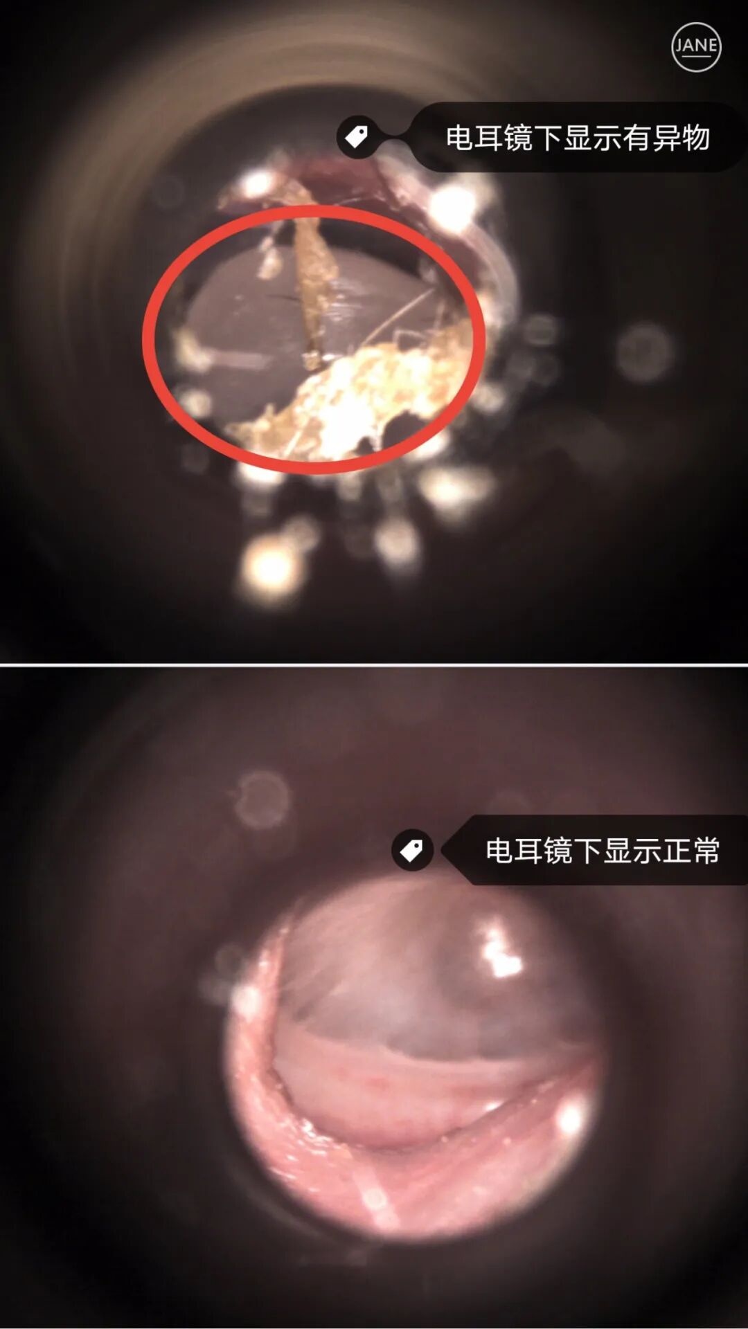 电耳镜检查能看出什么电耳镜检查发现三岁孩童耳中异物，取出来竟是这个！_https://www.jmylbn.com_新闻资讯_第3张