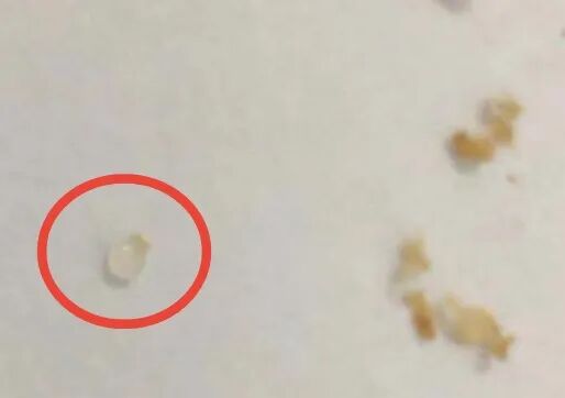 电耳镜检查能看出什么电耳镜检查发现三岁孩童耳中异物，取出来竟是这个！_https://www.jmylbn.com_新闻资讯_第2张