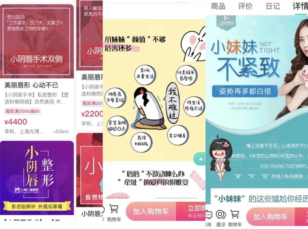 【两性】私处整形手术，正在侵蚀中国女孩的「外阴审美」（组图） - 2