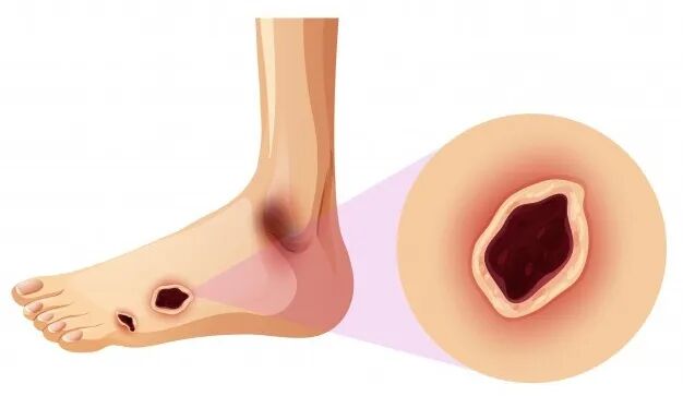 为什么糖尿病不能震动糖尿病足专科检查_https://www.jmylbn.com_新闻资讯_第1张