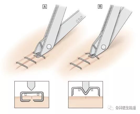 为什么要用皮钉缝合为啥有的伤口，是用钉书机给钉上的？_https://www.jmylbn.com_新闻资讯_第9张