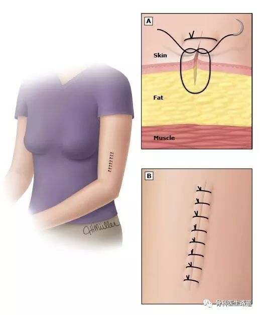 为什么要用皮钉缝合为啥有的伤口，是用钉书机给钉上的？_https://www.jmylbn.com_新闻资讯_第7张