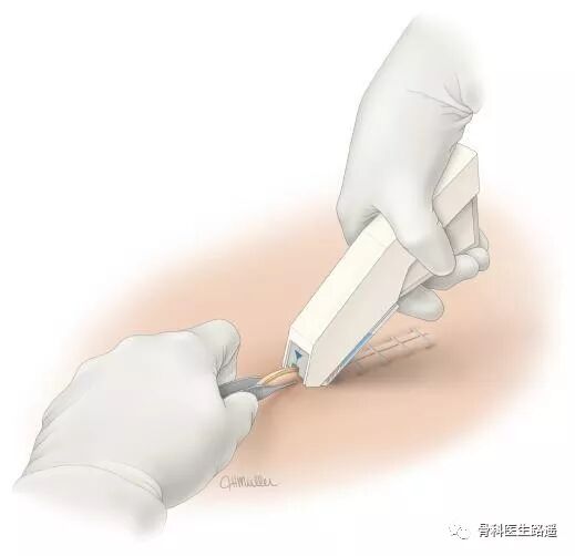 为什么要用皮钉缝合为啥有的伤口，是用钉书机给钉上的？_https://www.jmylbn.com_新闻资讯_第6张