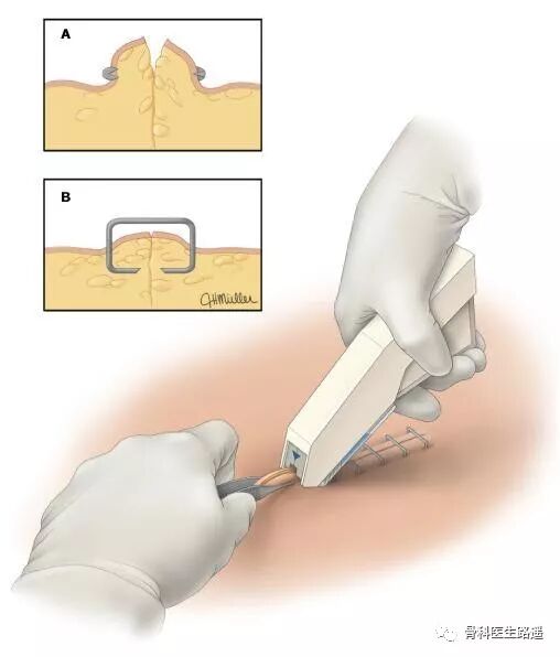 为什么要用皮钉缝合为啥有的伤口，是用钉书机给钉上的？_https://www.jmylbn.com_新闻资讯_第8张