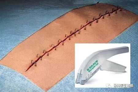 为什么要用皮钉缝合为啥有的伤口，是用钉书机给钉上的？_https://www.jmylbn.com_新闻资讯_第4张