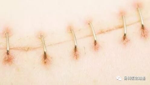 为什么要用皮钉缝合为啥有的伤口，是用钉书机给钉上的？_https://www.jmylbn.com_新闻资讯_第3张