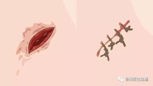 为什么要用皮钉缝合为啥有的伤口，是用钉书机给钉上的？_https://www.jmylbn.com_新闻资讯_第5张