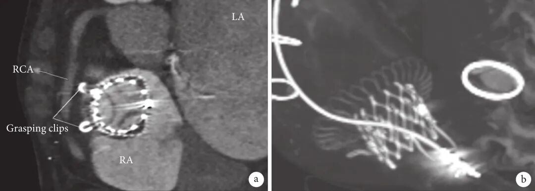 什么是电极导管经导管三尖瓣置换术治疗电极导线相关三尖瓣反流临床疗效的多中心回顾性队列研究_https://www.jmylbn.com_新闻资讯_第9张