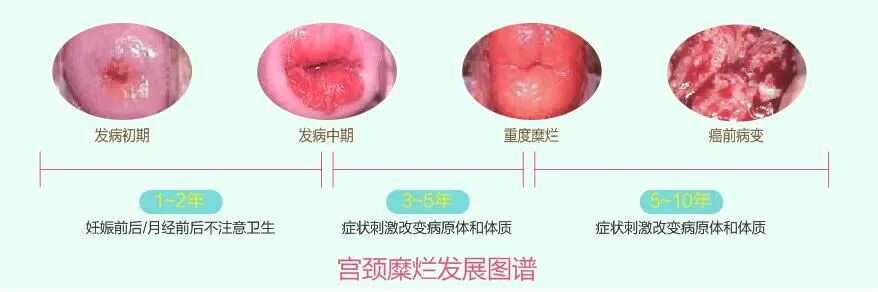 炎炎夏日 准确击退宫颈糜烂 养生堂 日常养生保健大全 养生小知识 微信头条新闻公众号文章收集网