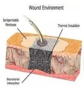 VSD怎么更换引流瓶「治疗」浅谈VSD技术(负压封闭引流术) 王钧 山西省中西医结合医院肾病一科_https://www.jmylbn.com_新闻资讯_第4张