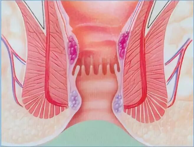 套扎器怎么用无锡东峰怡和 一次性使用肛肠套扎器使用简介_https://www.jmylbn.com_新闻资讯_第4张