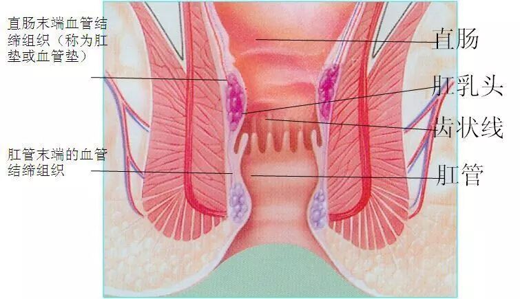 套扎器怎么用无锡东峰怡和 一次性使用肛肠套扎器使用简介_https://www.jmylbn.com_新闻资讯_第2张