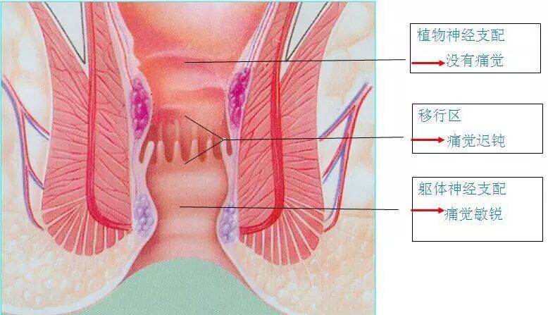 套扎器怎么用无锡东峰怡和 一次性使用肛肠套扎器使用简介_https://www.jmylbn.com_新闻资讯_第3张