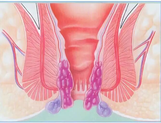 套扎器怎么用无锡东峰怡和 一次性使用肛肠套扎器使用简介_https://www.jmylbn.com_新闻资讯_第5张
