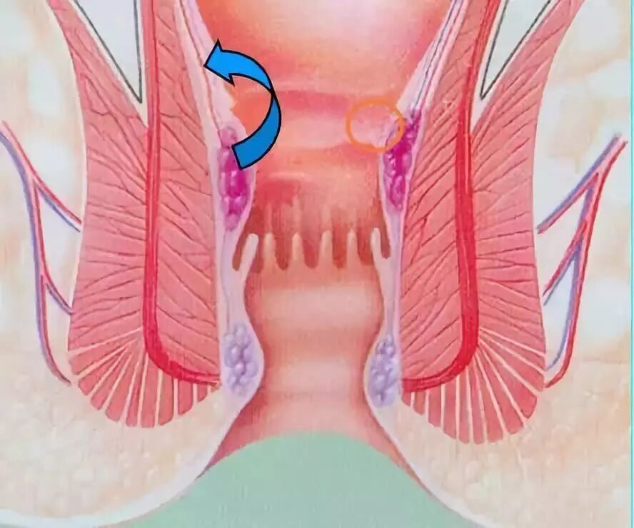 套扎器怎么用无锡东峰怡和 一次性使用肛肠套扎器使用简介_https://www.jmylbn.com_新闻资讯_第8张
