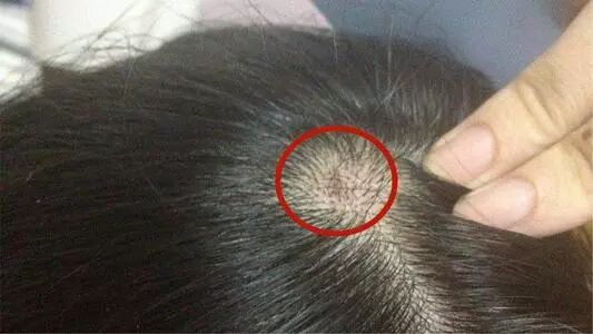 头皮上长的“小疙瘩”，或许是这3种疾病，千万不能大意！