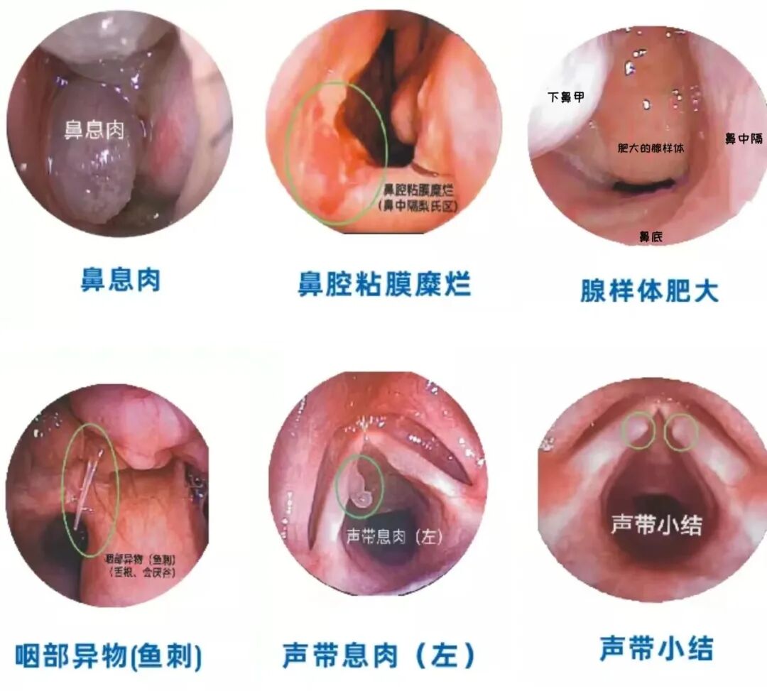 什么是电子鼻咽镜新服务｜鼻咽喉疾病如何“早”知道？我院新型电子鼻咽镜投入使用_https://www.jmylbn.com_新闻资讯_第5张
