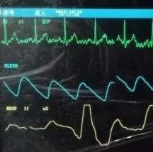 监护仪上的数据怎么看医院陪护中，学会看心电监护仪数据，开始学习吧！_https://www.jmylbn.com_新闻资讯_第6张