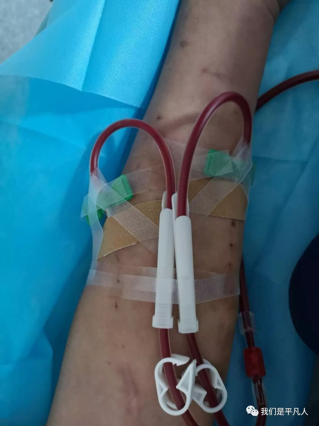 穿刺针怎么用透析护士｜使用后的透析用穿刺针，应如何处理呢？_https://www.jmylbn.com_新闻资讯_第13张