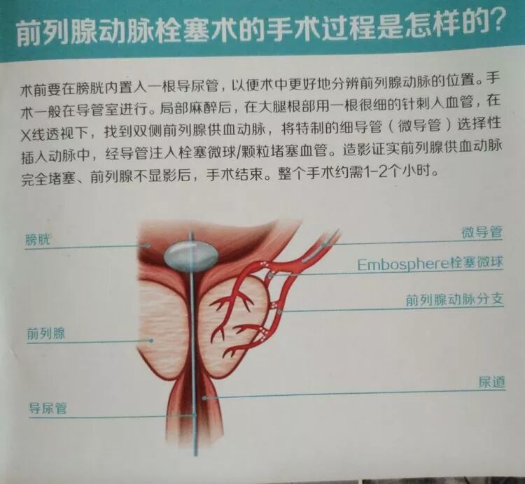 前列腺增生介入栓塞治疗效果好 副作用少 前列腺增生