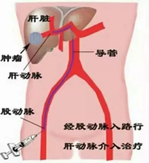 介入治疗能治哪些病？创伤小效果好，赶紧收藏