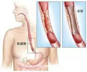 介入治疗能治哪些病？创伤小效果好，赶紧收藏