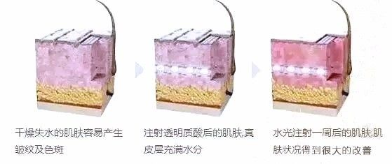 无针水光+超声刀,让你拥有水润肌肤! 无针水光+超声刀,让你拥有水润肌肤!