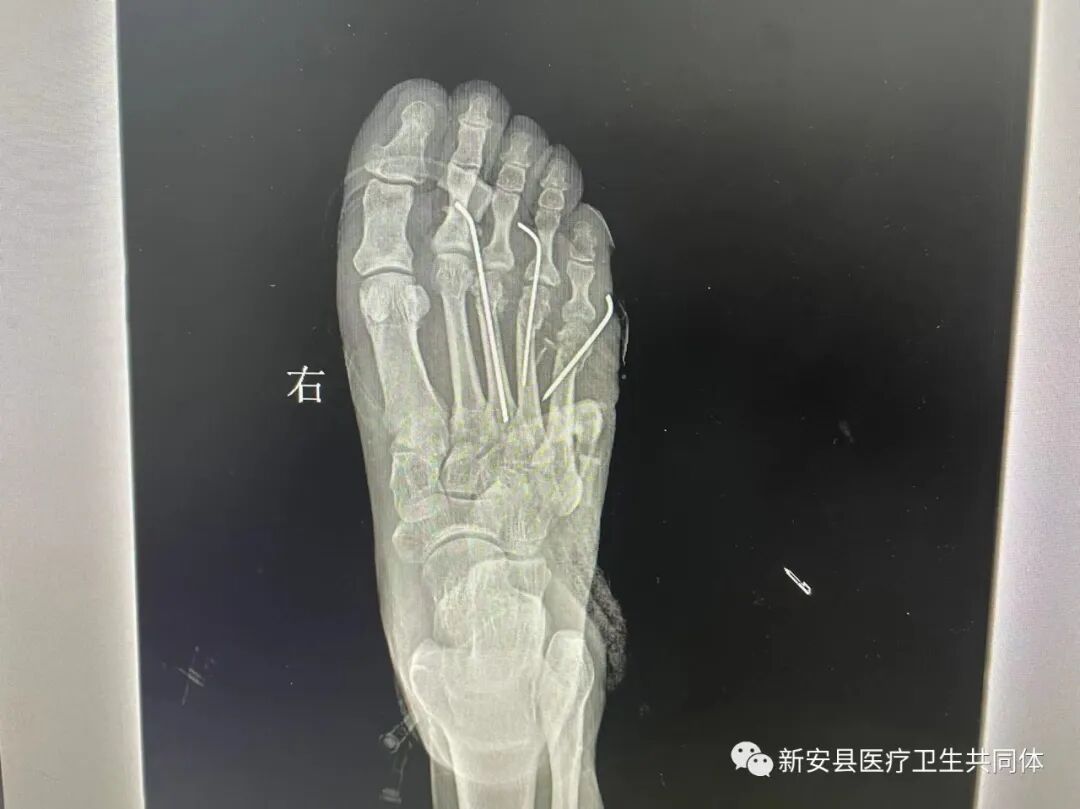 vsd引流器怎么连接【医共体动态】新安医共体第二人民医院手足伤病治疗中心成功应用VSD负压封闭引流技术_https://www.jmylbn.com_新闻资讯_第2张