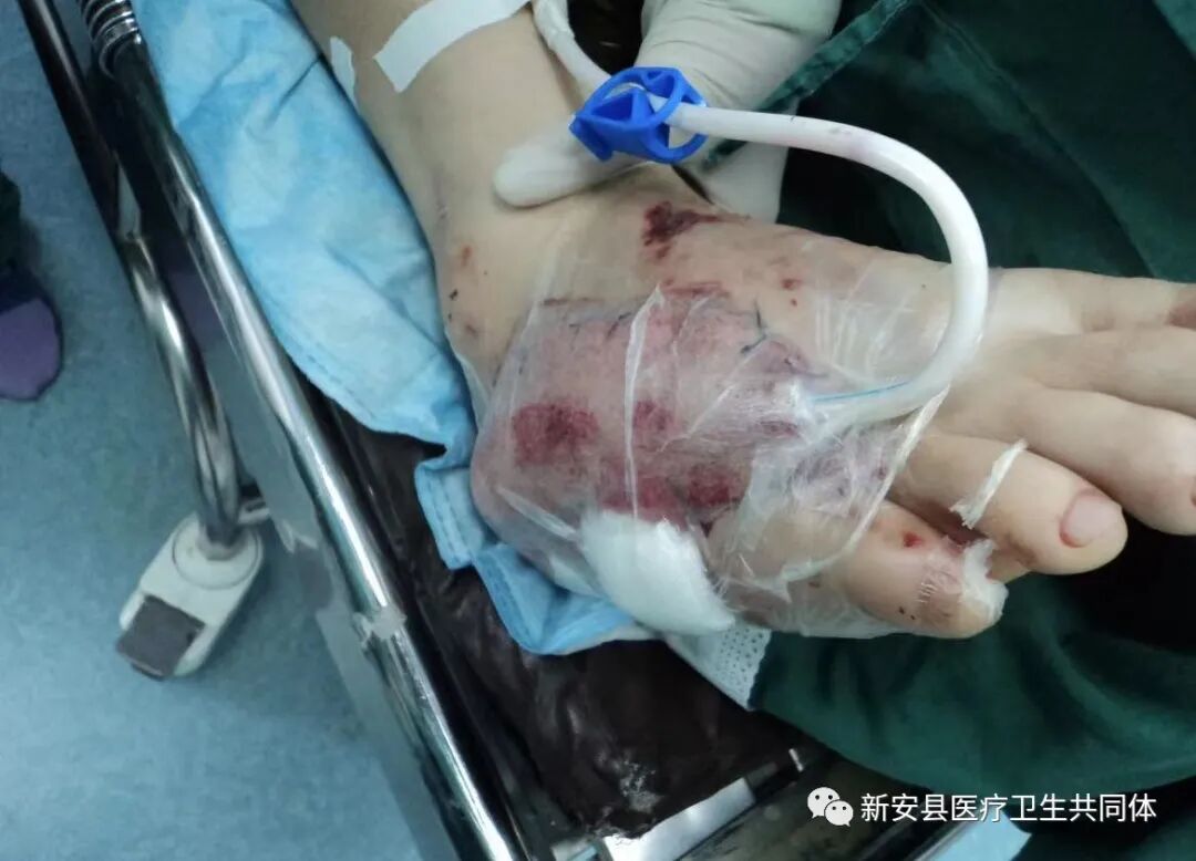 vsd引流器怎么连接【医共体动态】新安医共体第二人民医院手足伤病治疗中心成功应用VSD负压封闭引流技术_https://www.jmylbn.com_新闻资讯_第3张