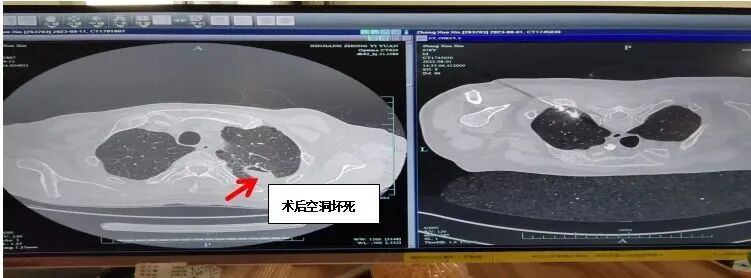 微波针是什么【新闻快递】呼吸一科：肺癌微波消融术——小细针解决大问题_https://www.jmylbn.com_新闻资讯_第12张