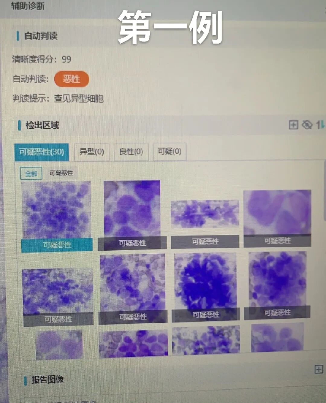 病理切片快递怎么包装【新闻快递】呼吸一科率先开展AI-ROSE人工智能现场快速病理诊断技术_https://www.jmylbn.com_新闻资讯_第5张