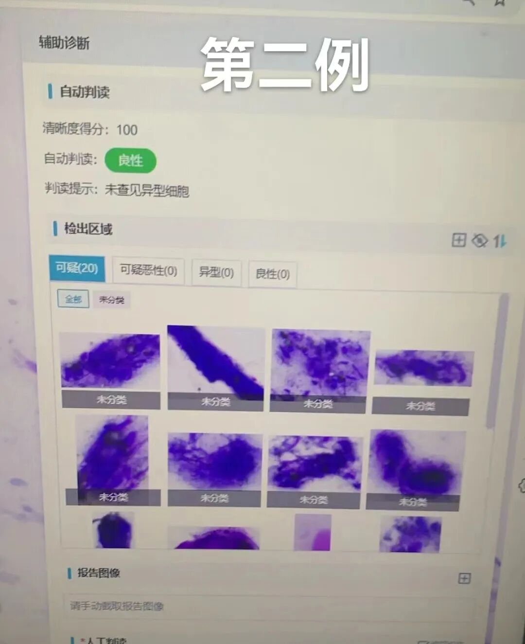 病理切片快递怎么包装【新闻快递】呼吸一科率先开展AI-ROSE人工智能现场快速病理诊断技术_https://www.jmylbn.com_新闻资讯_第6张